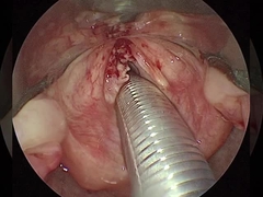 4채널 ENT 표준 3선 액티브 전극을 가진 외과 도구
